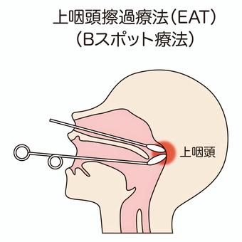 上咽頭の治療の方法